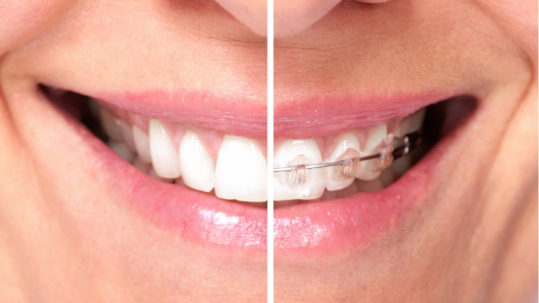 Ortodonzia 1 | Studio dentistico a Fiorano al serio | Studio dentistico Mbm